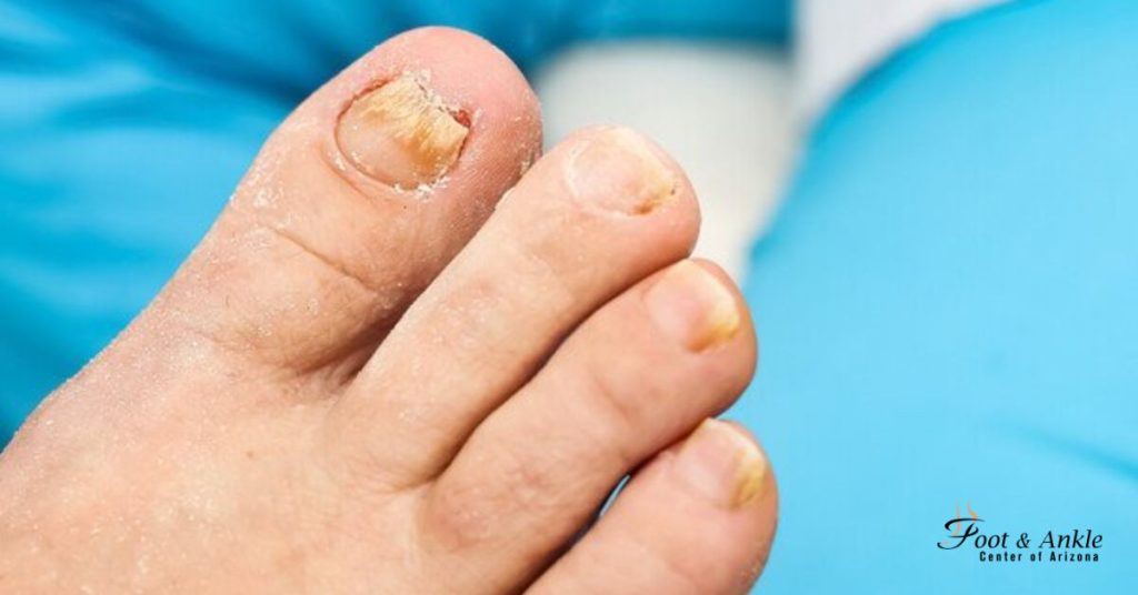 What causes a toenail fungus