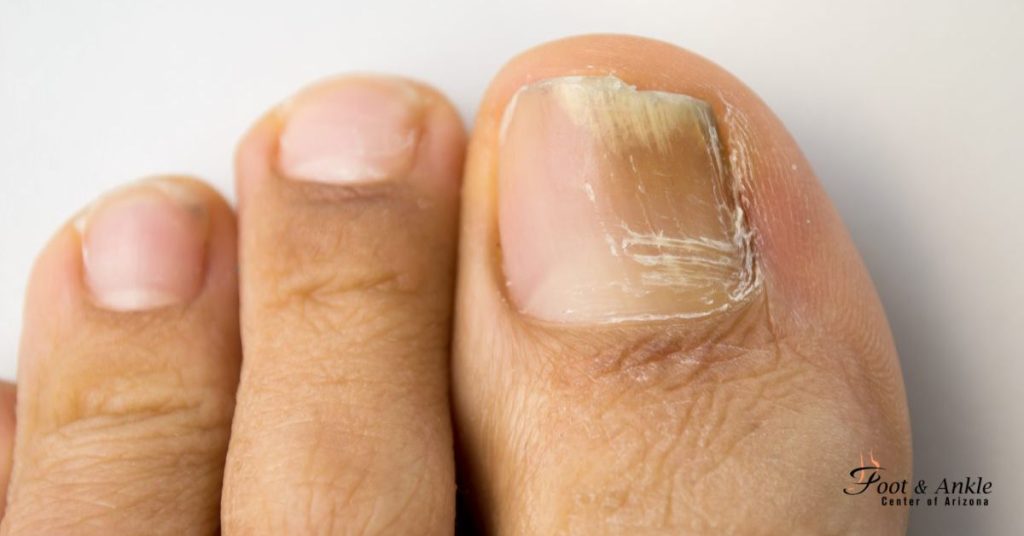 How to get rid to toenail fungus