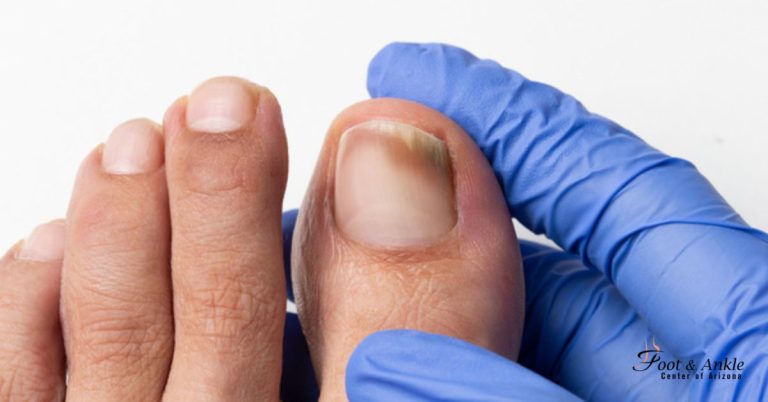 Laser therapy for toenail fungus