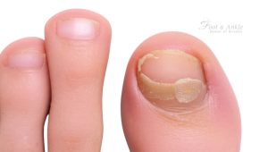 Why is my toenail yellow