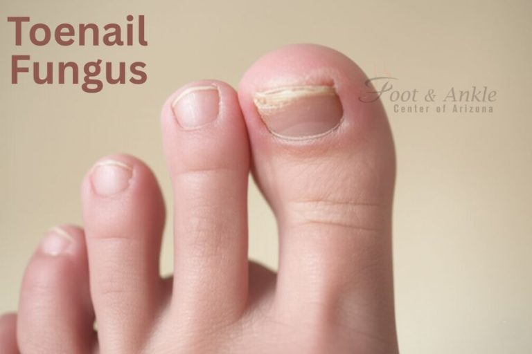 Toenail Fungus