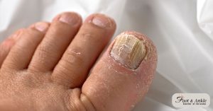 How Can I Treat Toenail Fungus