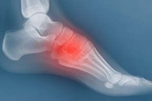 Metatarsal Stress Fracture