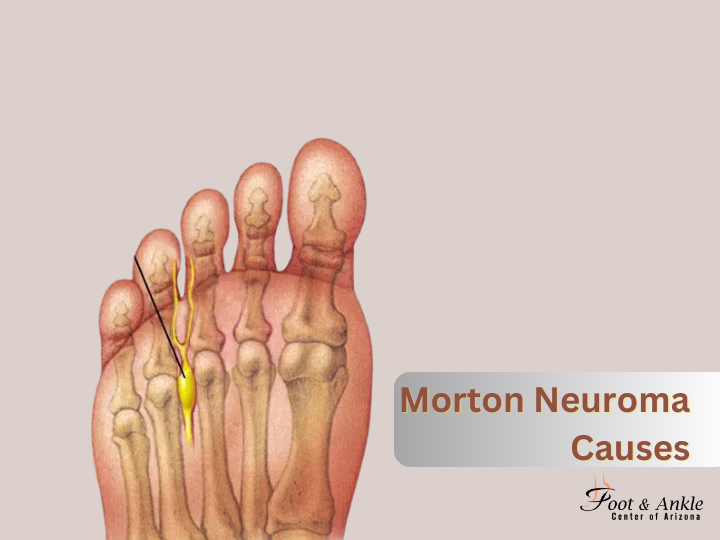 Morton Neuroma Causes