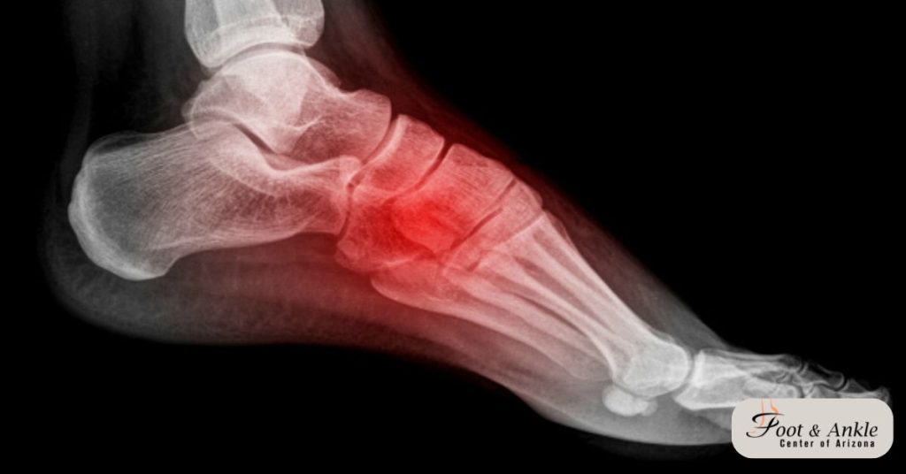 Stress Fracture of Metatarsal Bone