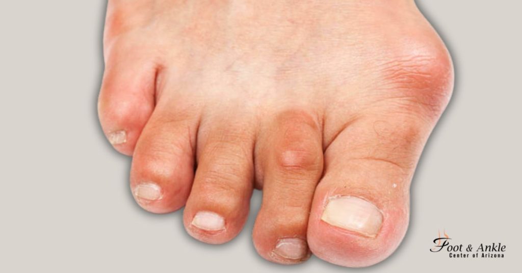 What is a Bunion on Your Foot