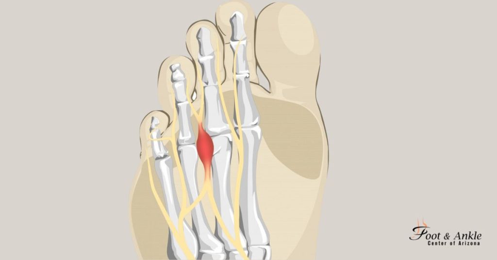 What is the best treatment for Morton's neuroma