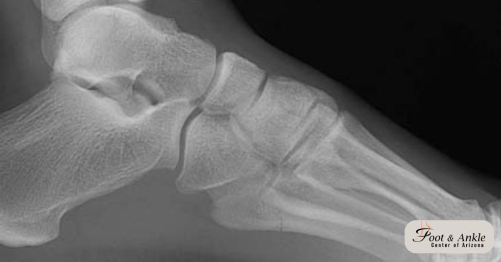 base of 5th metatarsal fracture