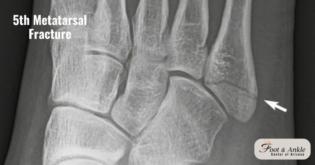 5th metatarsal fracture