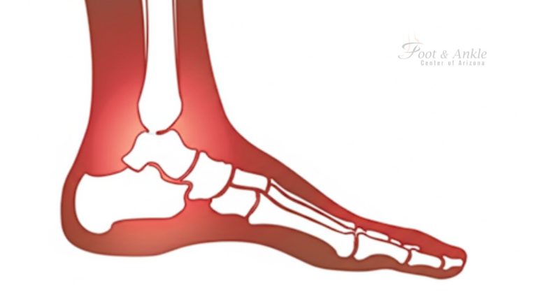 Damaged Ligaments in Foot