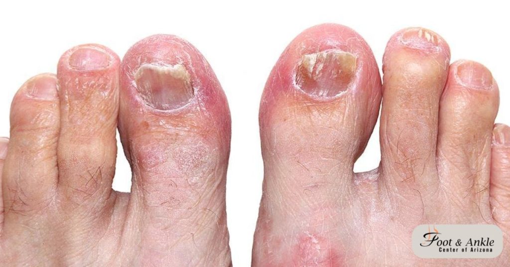 How to Get Rid of a Toe Infection