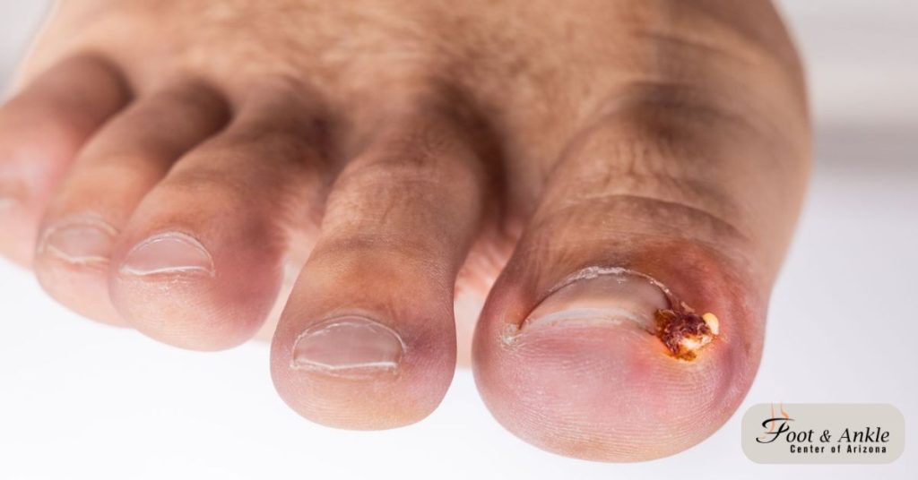 How to Heal a toe infection