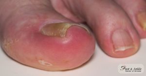 How to Soak an Infected Toe