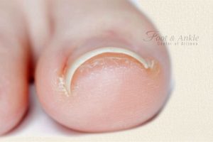 How to drain an infected toe