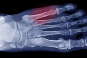 Metatarsal Fracture Treatment