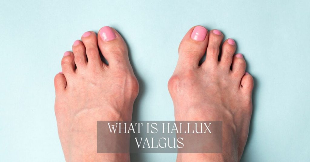 What is Hallux Valgus