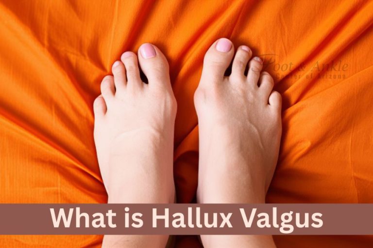 What is Hallux Valgus