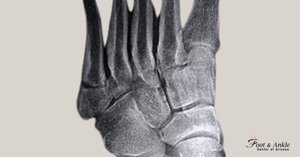 What is a 5th metatarsal fracture