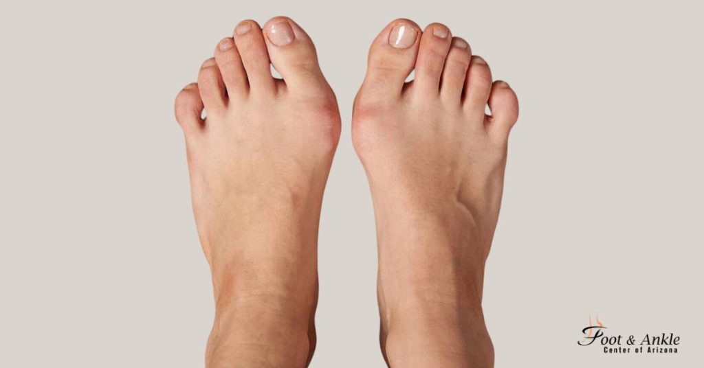 How to Relieve Bunion Pain When Walking