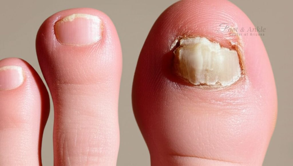 What Causes a Hammer Toe