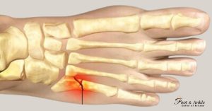 Bone on Outside of foot hurts