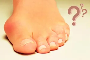 What is a Bunion