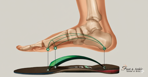 Custom shoe orthotics
