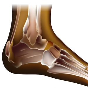 Haglund Deformity