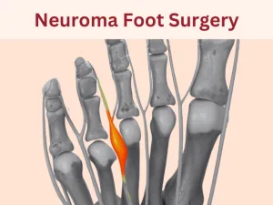 Neuroma Foot Surgery