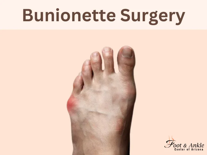 Bunionette Surgery