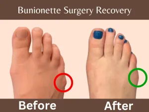 Bunionette Surgery Recovery