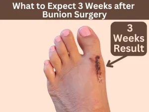 what to expect 3 weeks after bunion surgery