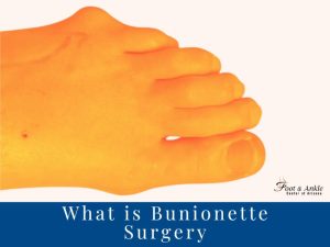 What is Bunionette Surgery