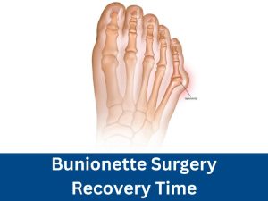 Bunionette Surgery Recovery Time