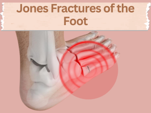 Jones Fractures of the Foot