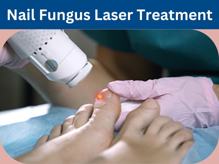 Nail Fungus Laser Treatment