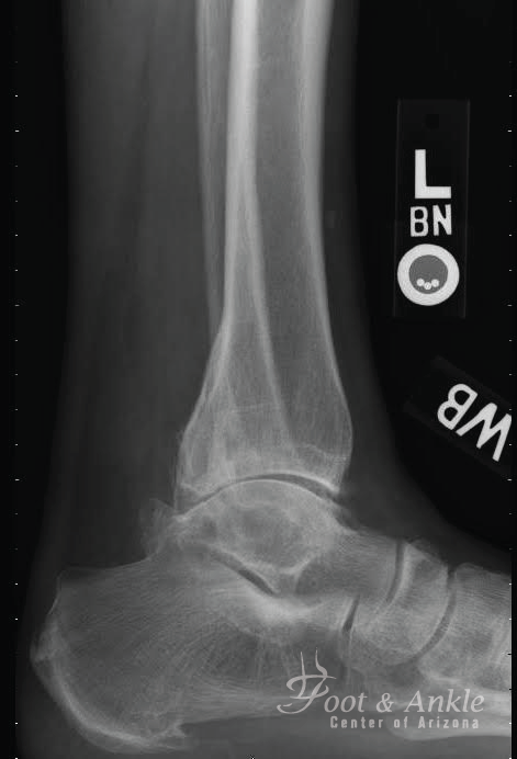 Total Ankle Replacement 3