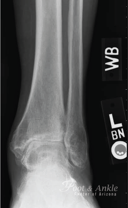 total ankle replacement X-Ray