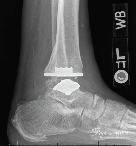 Total Ankle Replacement 1