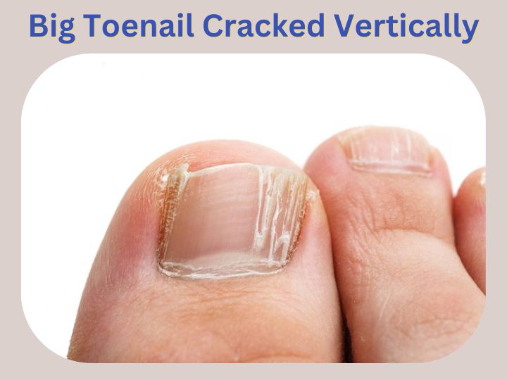 Big Toenail Cracked Vertically