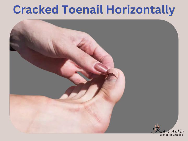 Cracked Toenail Horizontally