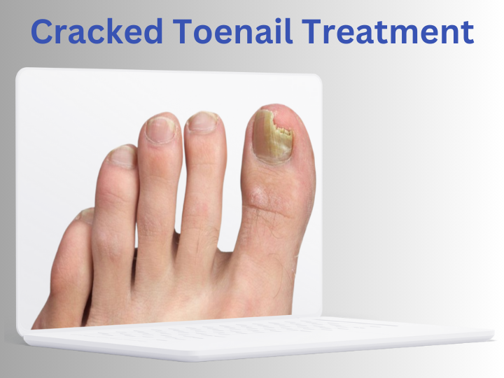 Cracked Toenail Treatment