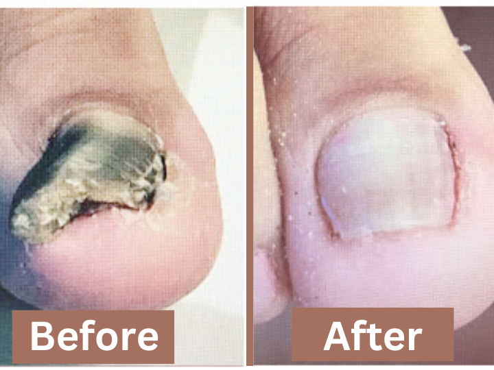 Cracked Toenail before and after (2)