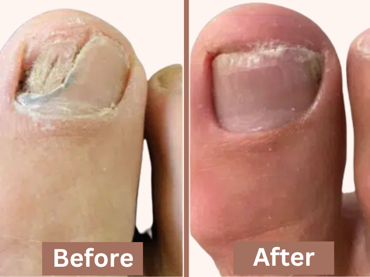 Cracked Toenail before and after