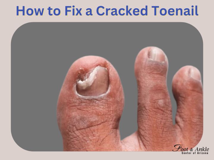 How to Fix a Cracked Toenail