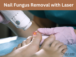 Nail Fungus Removal with Laser