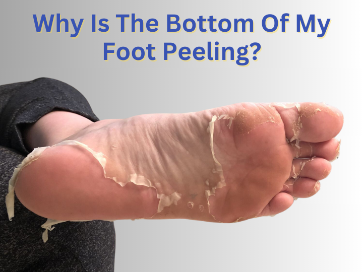 Why Is The Bottom Of My Foot Peeling