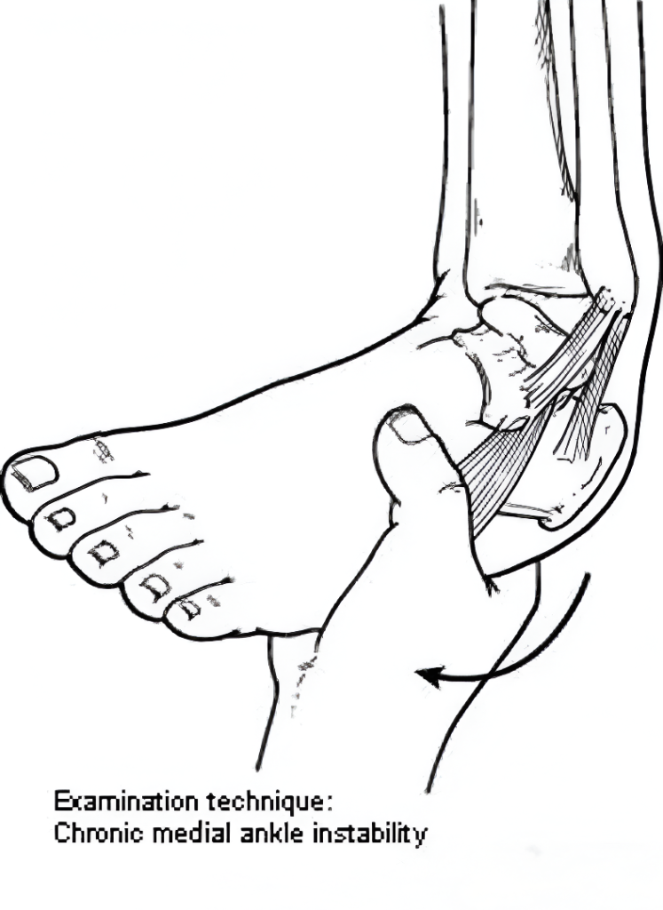 Chronic Ankle Instability