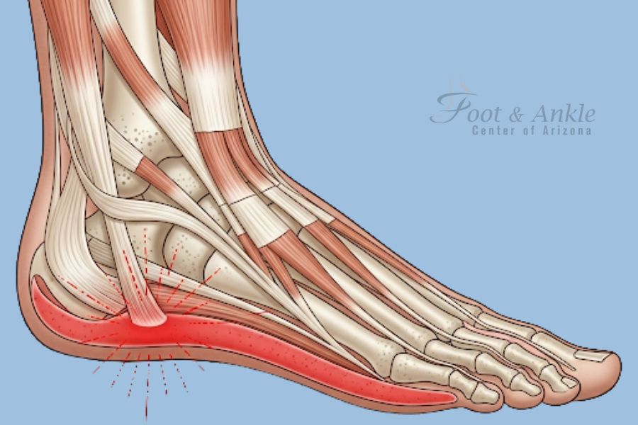 How to Treat a Sprained Ankle