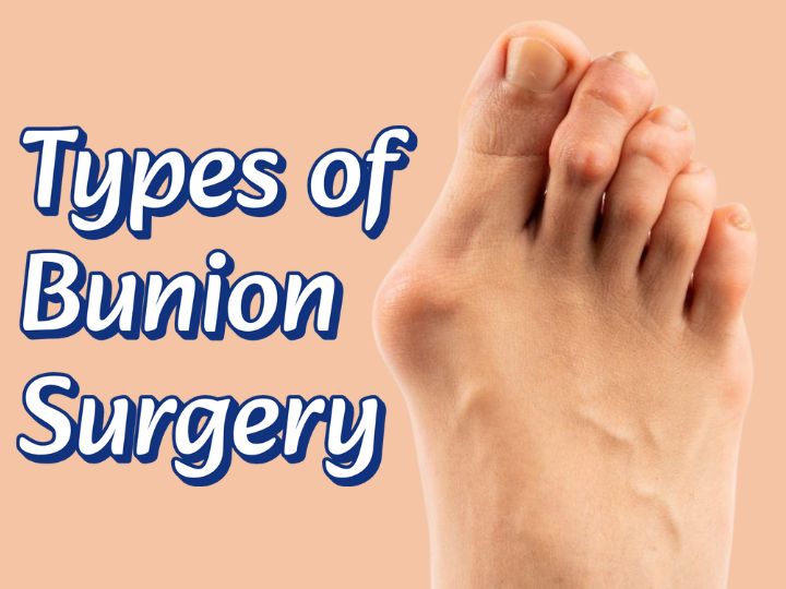 Types of Bunion Surgery